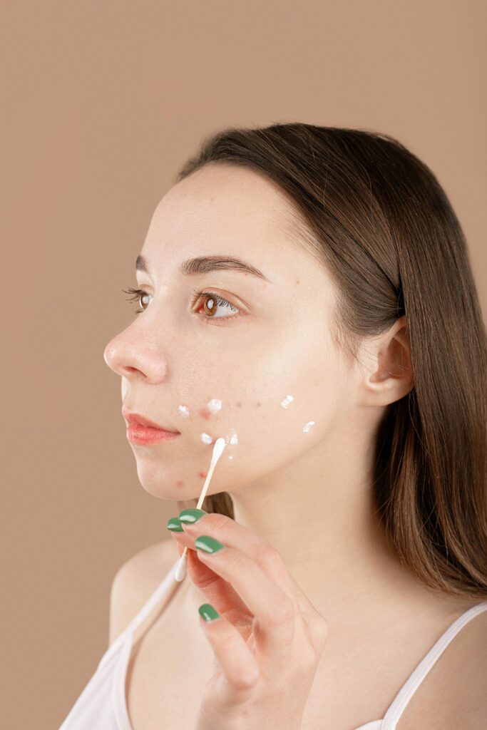 A young woman applies acne treatment cream on her face, focusing on skincare and facial care.
